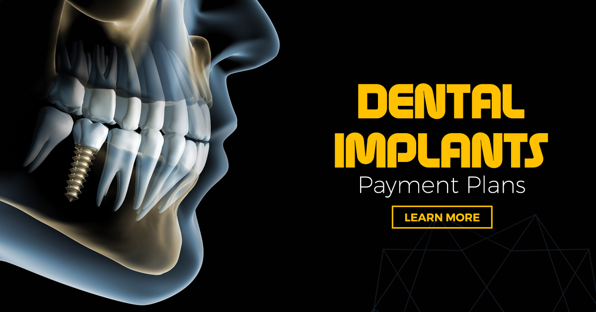 Cost of Dental Implants in Modesto, CA