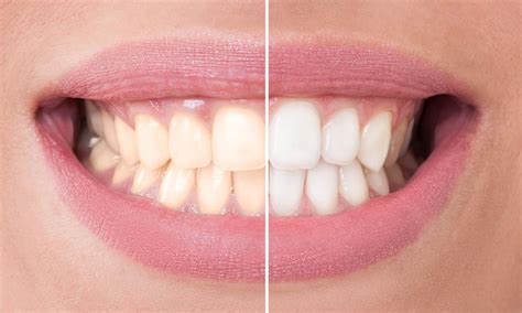 types of teeth whitening treatments
