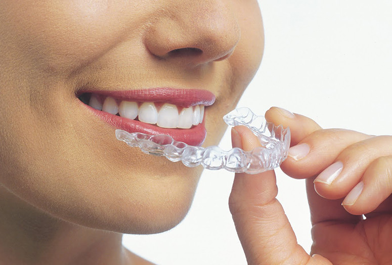 invisalign-braces-for-teeth