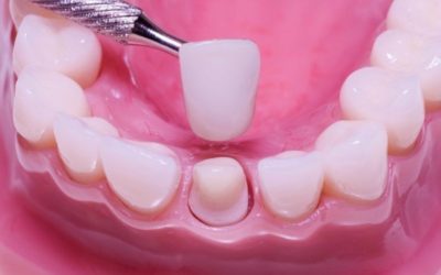 Dental Crown Treatment Procedure – How to Get Started