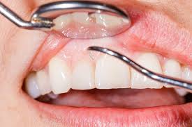 deep-teeth-cleaning-gum-disease