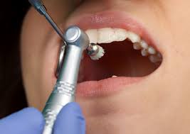 affordable deep-teeth-cleaning-modesto