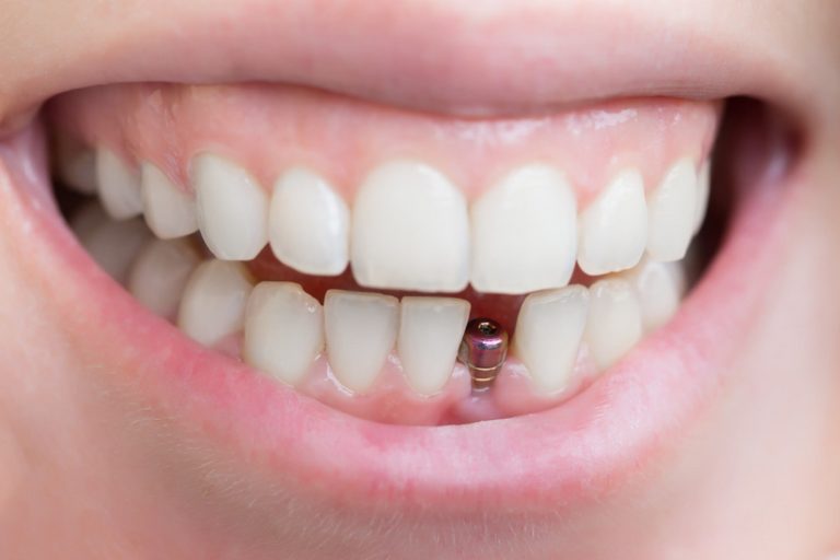 affordable dental implant treatment specialist modesto