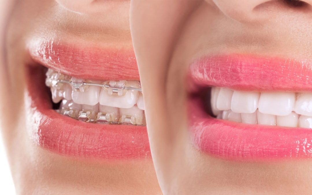 What is Invisalign and Metal Braces? How Do They Work?