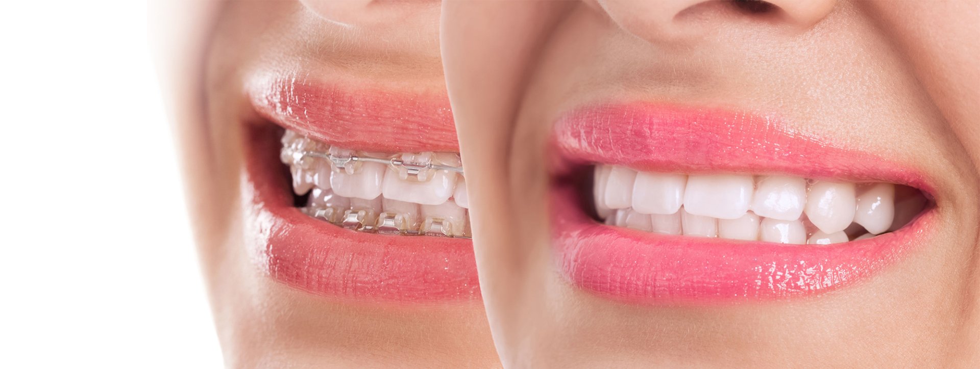 Invisalign are considered better than metal braces