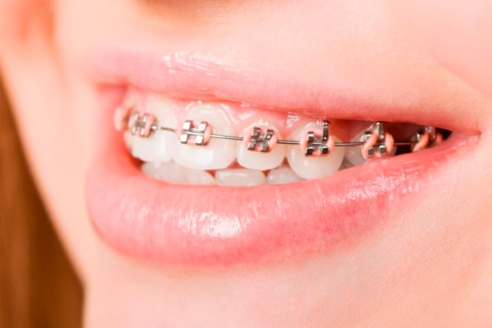 Modesto Invisalign Dentist
