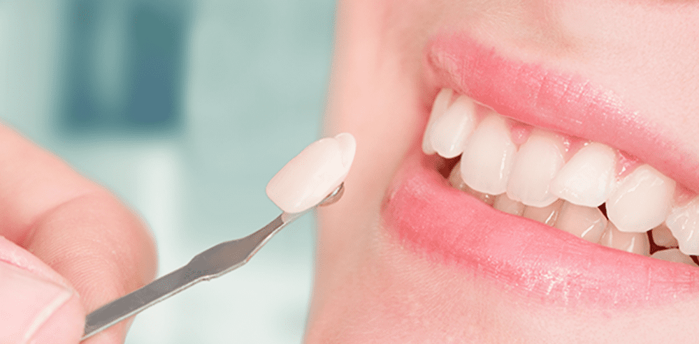 ProSmile Family dental provides veneer treatment in Modesto CA