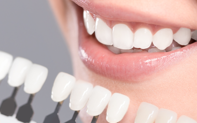 What are Veneers and How Dental Veneers Saved Our Smiles?