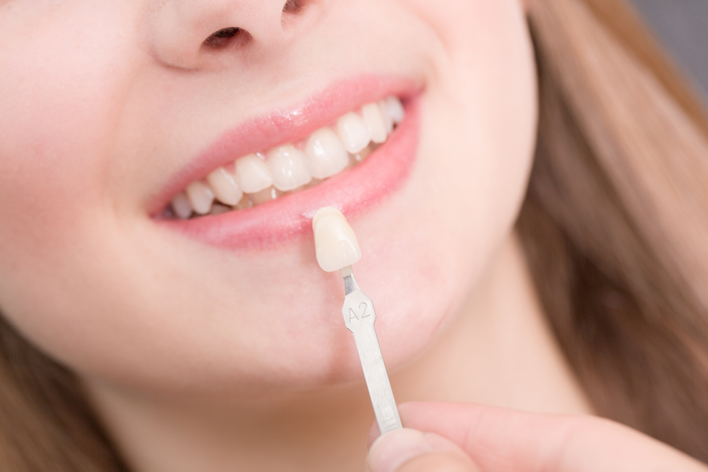 Veneer is the best treatment for whitening your teeth