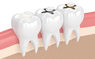 Why tooth colored fillings are in trend