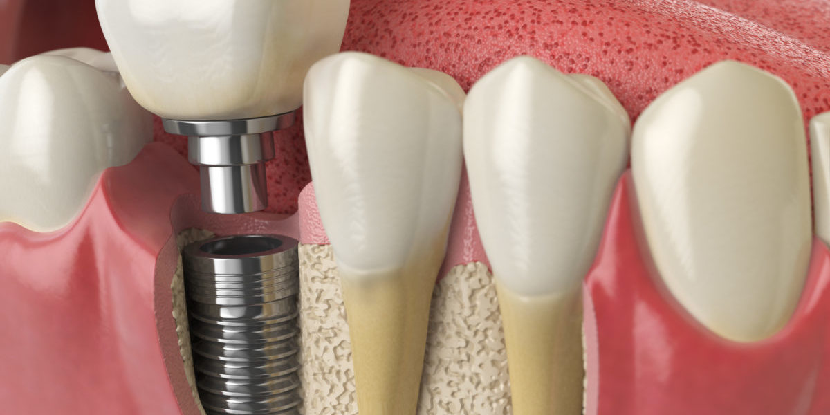 Implant supported dental bridge
