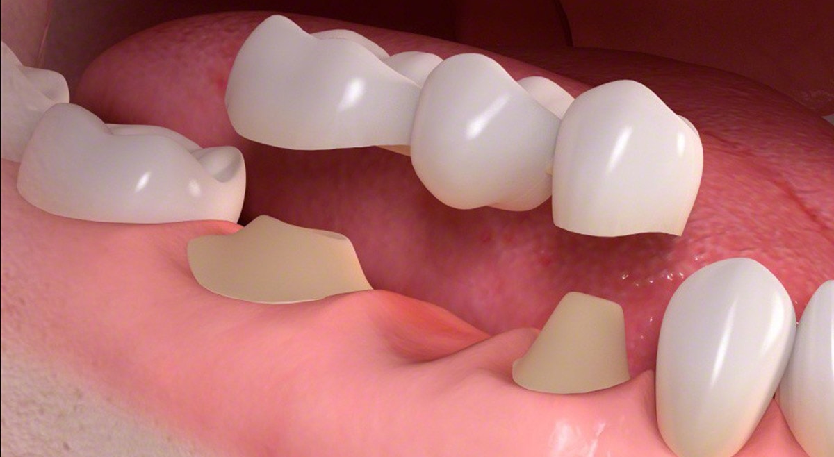 • Traditional dental bridge treatment
