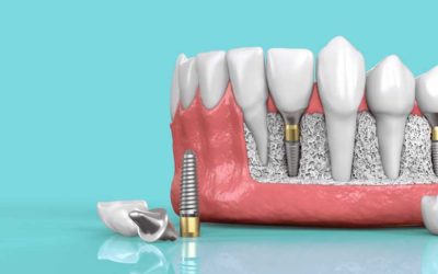 Types of dental implants and techniques