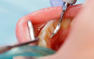How Dental Scaling is Done for Deep Cleaning of Teeth