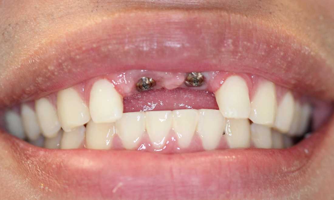 Implant dentist Modesto