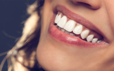 What types of Dental Veneers are popular?