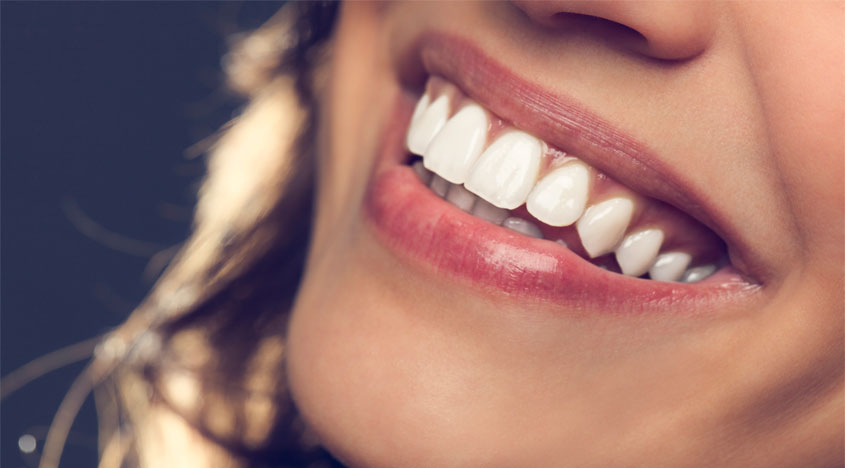 What types of Dental Veneers are popular?