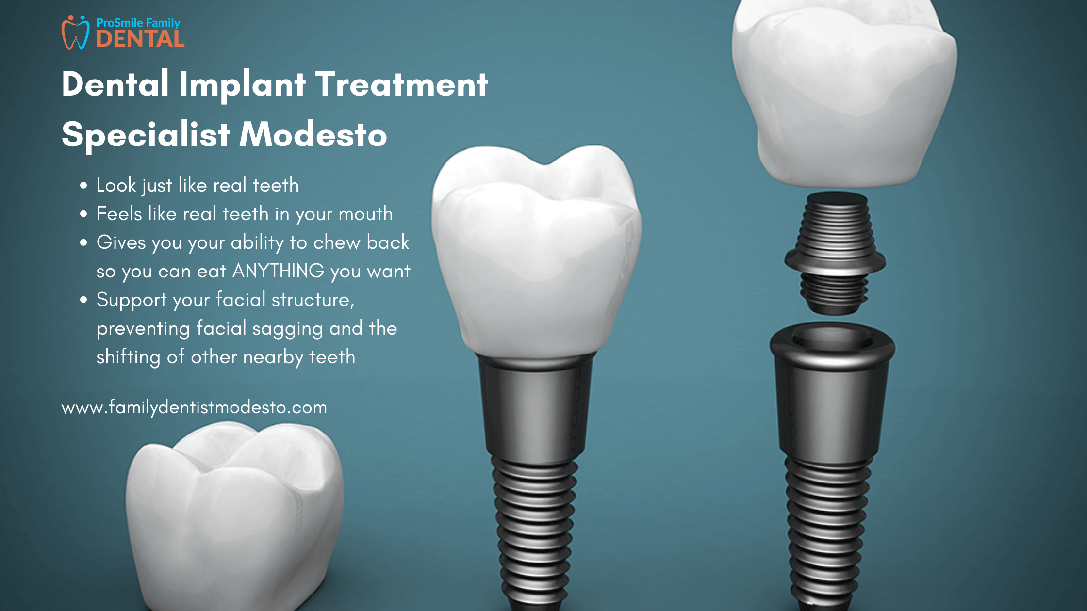 Implant dentist modesto