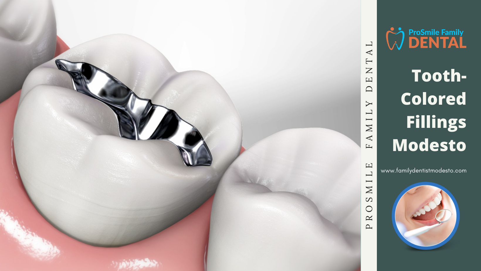 Tooth-Colored Fillings Modesto