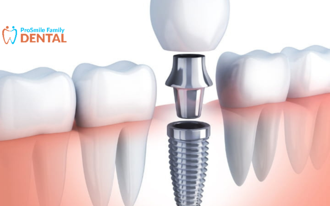 How Dentist Modesto professionals can do your dental implants effectively?