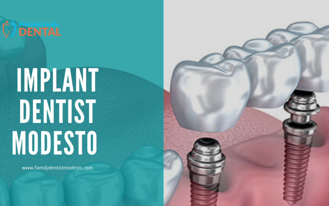 How implant dentist Modesto services can improve your oral health?