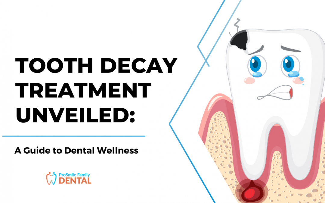 Tooth Decay Treatment Unveiled: A Guide to Dental Wellness