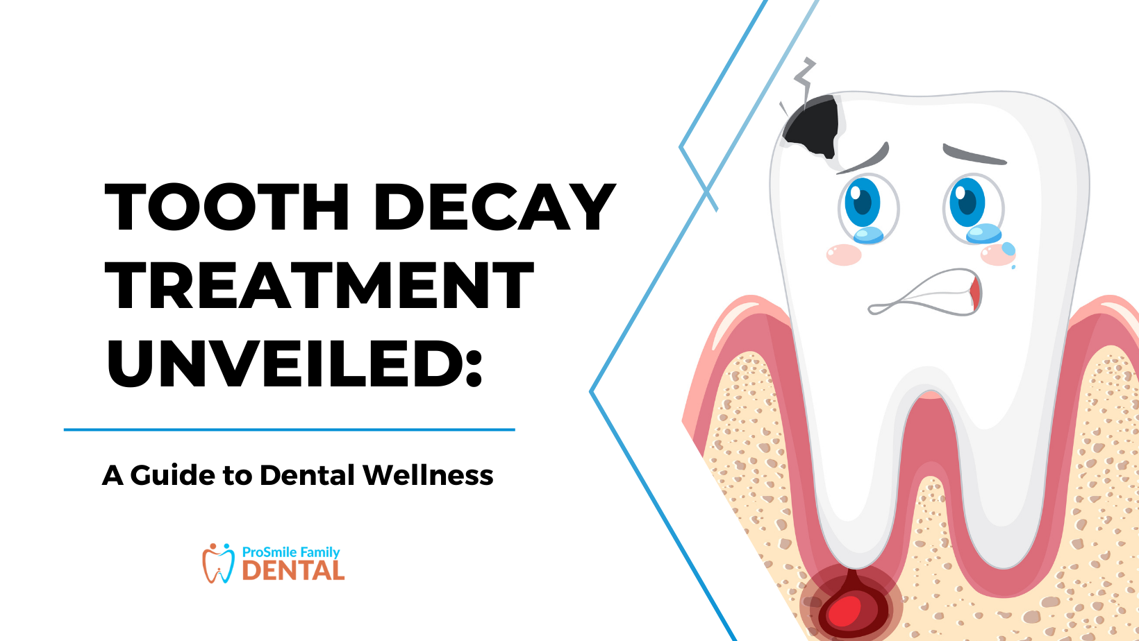 Tooth Decay Treatment in Modesto, CA