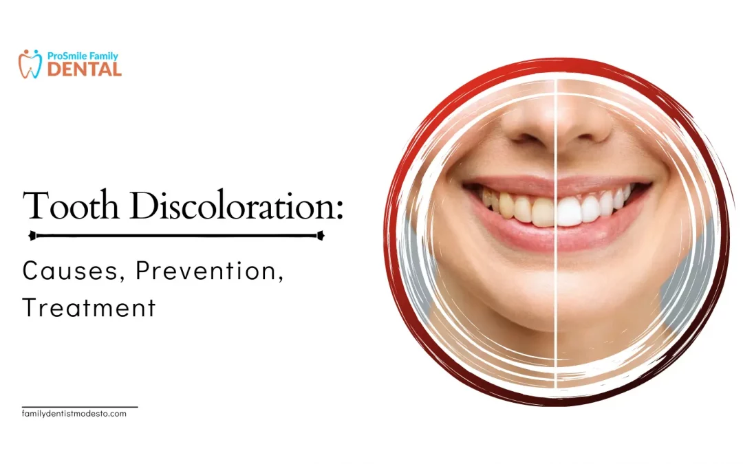 Tooth Discoloration - Causes, Prevention, Treatment