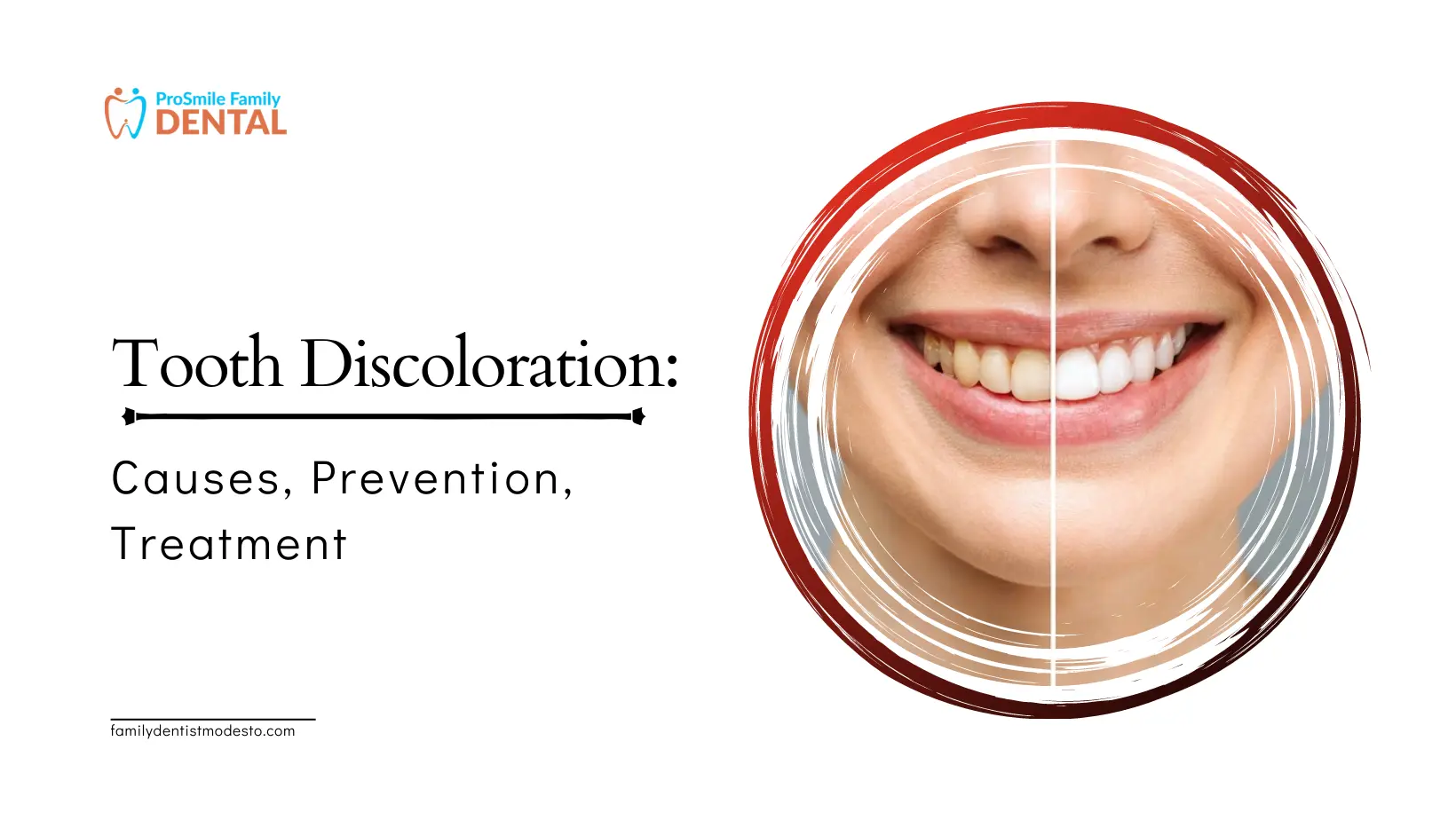 Tooth Discoloration - Causes, Prevention, Treatment